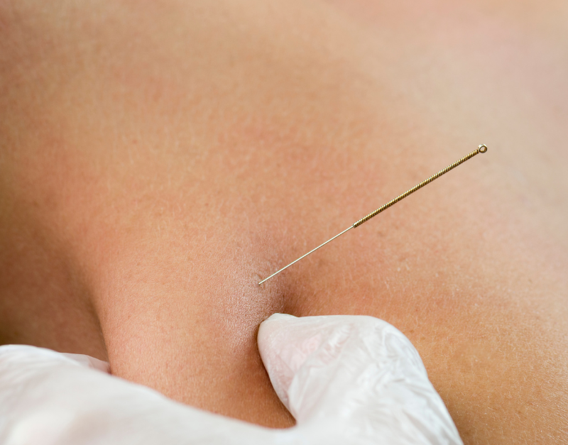 dry needling physiotherapy near me gurgaon
