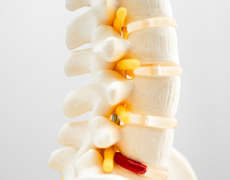 Herniated Slipped Disc Treatment in Gurgaon At Home