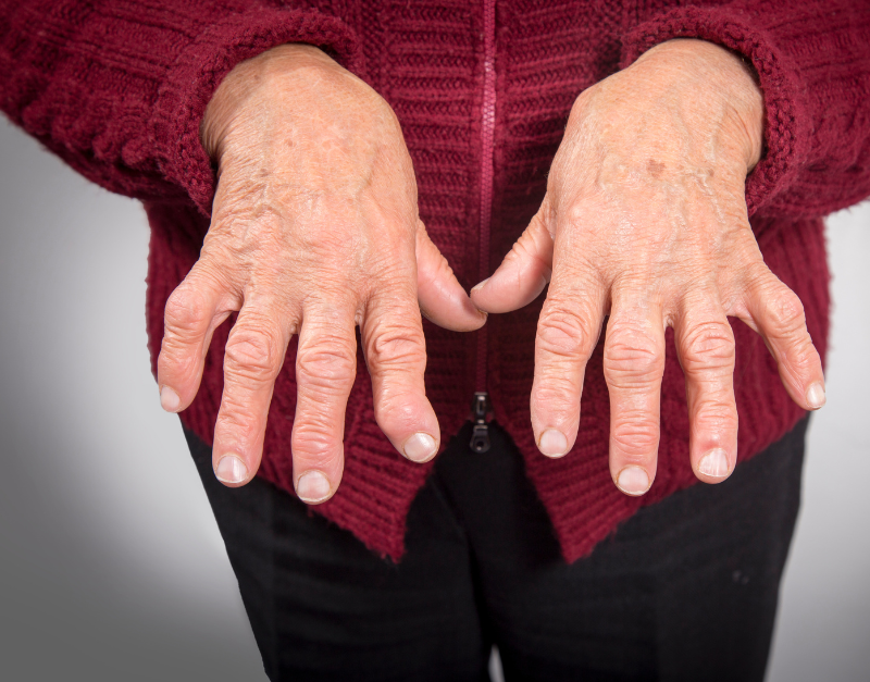 Rheumatoid Arthritis Physiotherapy
