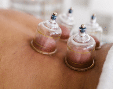 Cupping Therapy