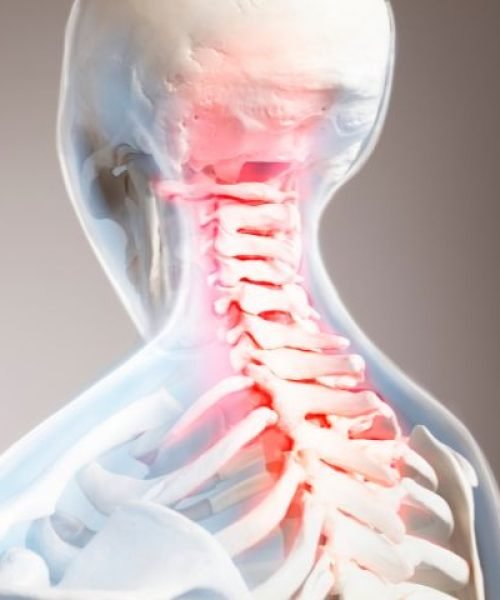 Cervical Spondylosis Physiotherapy